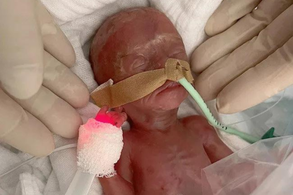 Bebê nasce 16 semanas antes do previsto e é chamado de milagre da vida